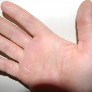 Hand after picking up a hot pan.